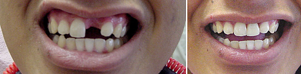 Youth incisor single dental-implant